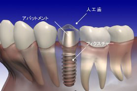 インプラント