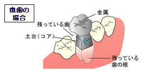 奥歯の場合