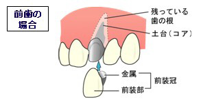 前歯の場合