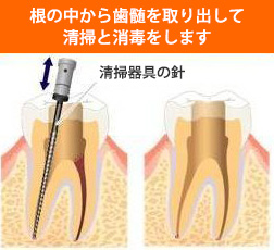 歯の根の治療