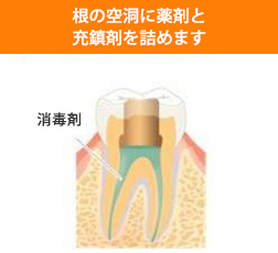 歯の根の治療